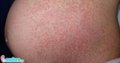 ลมพิษในหญิงตั้งครรภ์