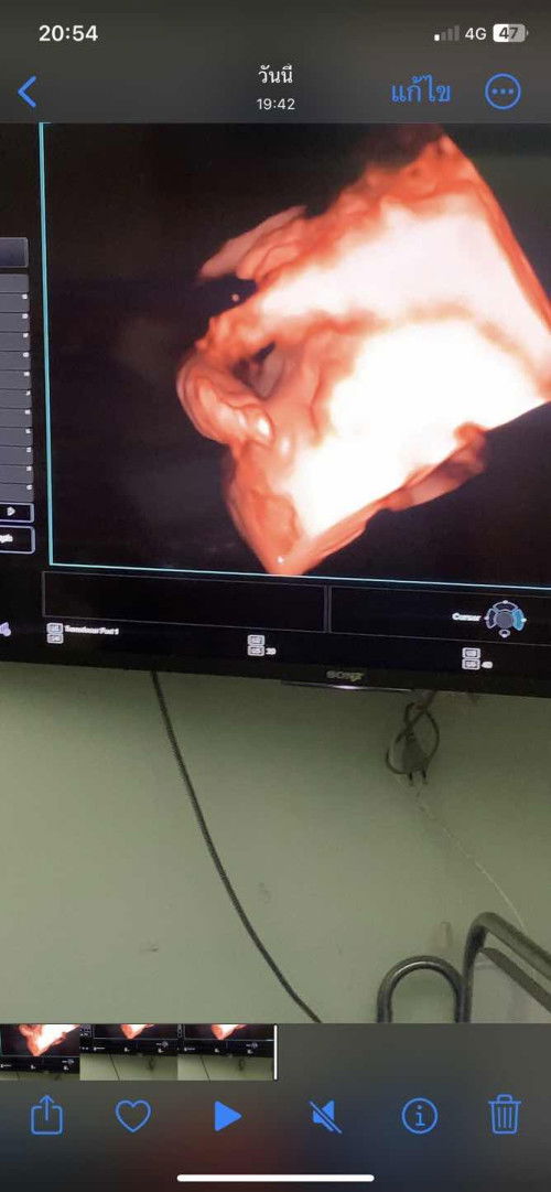 กลัวลูกเป็นเท้าปุก