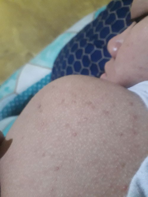 bentol bentol di punggung