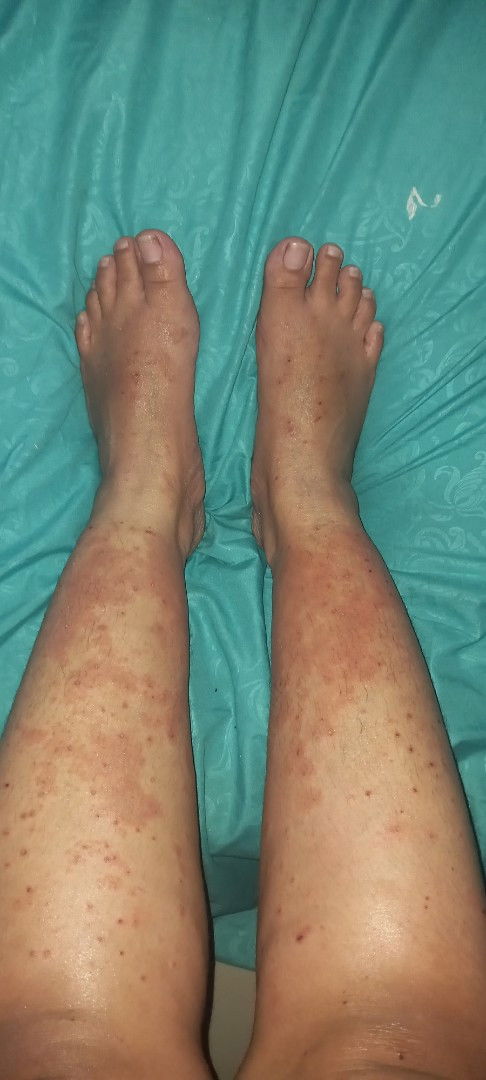 Ada yang sm ga ya gatal2 sebadan2 dr 37w sampai sy lahiran sampai skrg masih hiks ini knp&sampai kpn