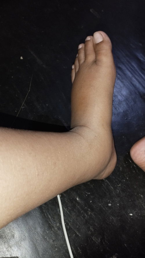 Kaki bengkak di TM 3