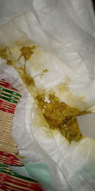 อึแบบนี้ต้องไปหาหมอมั้ยคะ