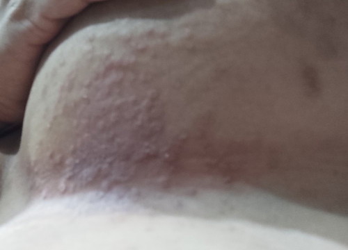 underboob rashes ng buntis