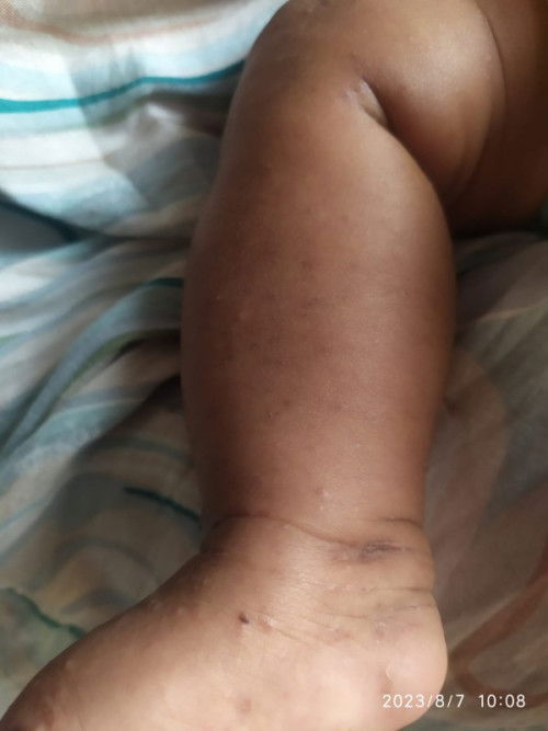 cara menghilangkan hitam2 bekas bentol