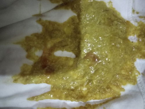 Bayi 8 bulan diare, maaf fotonya agak jijik..