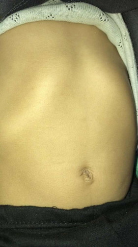 Tulang rusuk yang menonjol