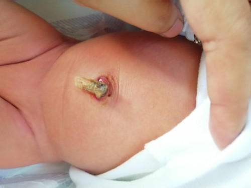 Mga mommies ano ba Pwede ko ilagay sa umbilical cord ni baby? Mukhang na infected po kasi medyo basa