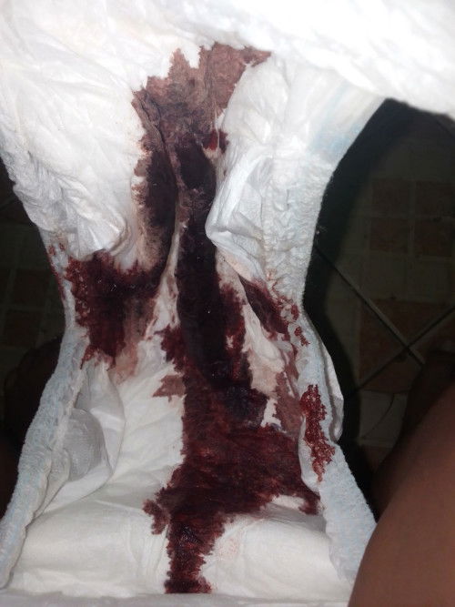 Keluar darah lagi setelah 13 hari melahirkan secara SC