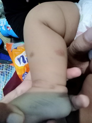 Obat untuk ruam pada kulit bayi 3 ½ bulam apa ya? Soalnya sudah 4 kali ke bidan tp tidak ada hasinya