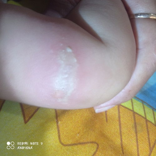 Bayi 4 bulan kena herpes