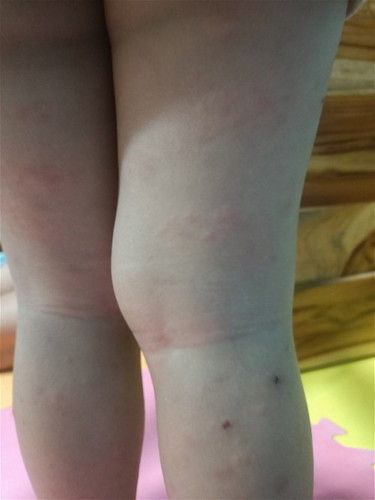 Rashes ni toddler