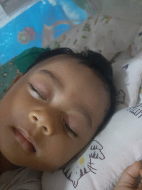 Mata Belekan dan tertutup lengket saat tidur