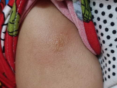 rashes or insect bites