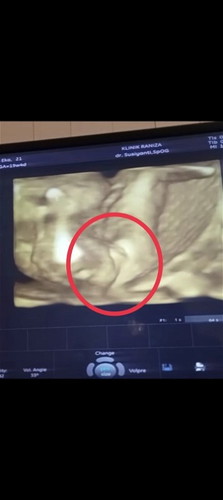 Bun , mau tanya dong ini JK nya cewek atau cowok ya? Itu posisi bayi nya lagi ngangkang?