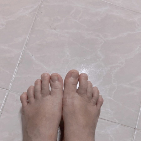 เท้าบวมตอน31week