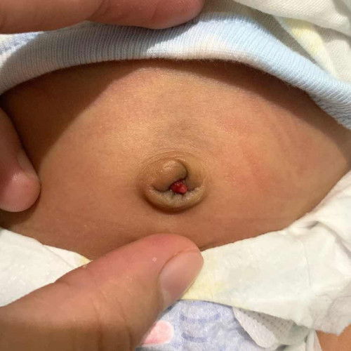 umbilical granumola????