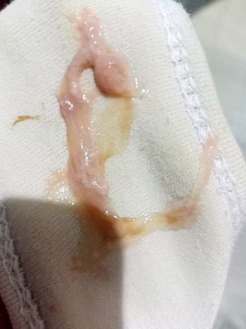 Keluar lendir kecoklatan