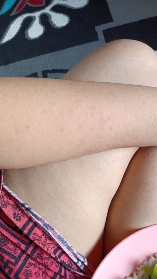 Gatel² setalah melahirkan