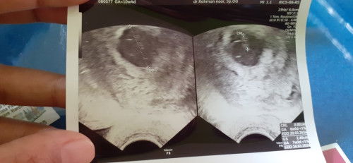 Hpht 10w4d tapi di USG 7w3d