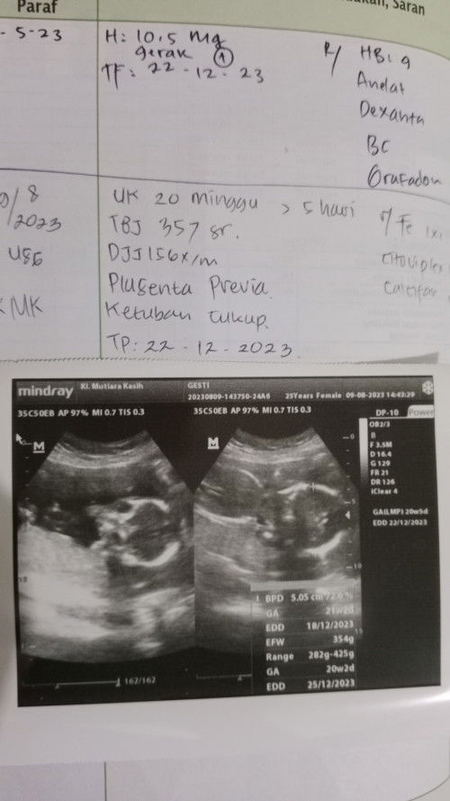 Placenta previa 🥲