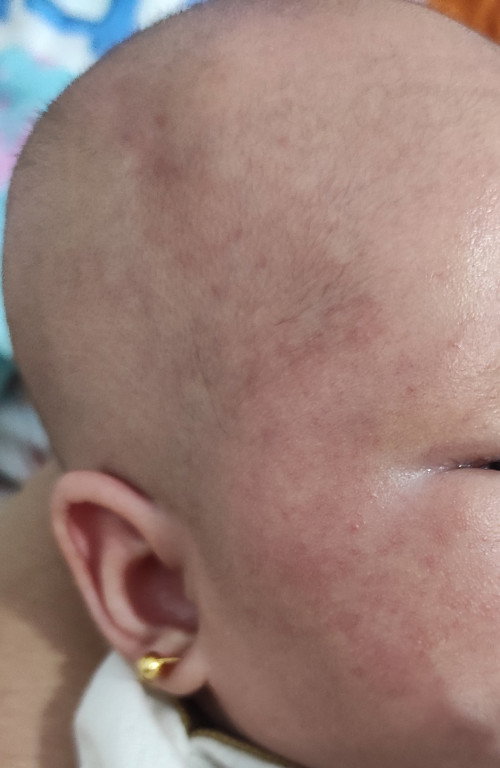 Cara atasi ruam merah pada pipi