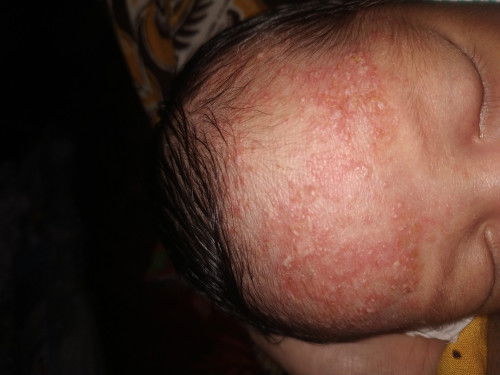 Bruntusan pada bayi newborn