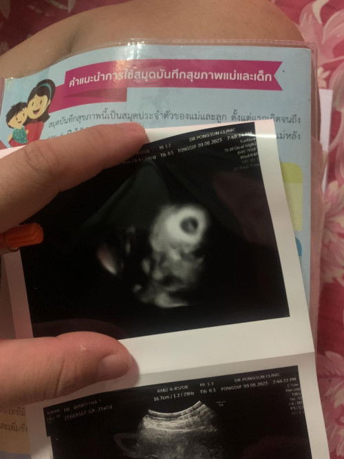 ปากแหว่งไหมคะแบบนี้