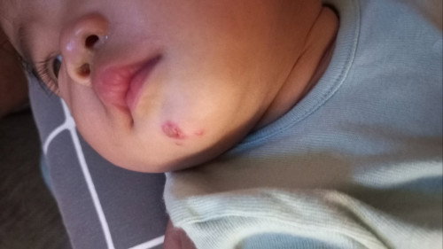 Bun mau tanya, awalnya krn abis makan telor lalu muncul spt bisul. Sekarang melebar