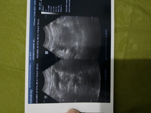 Assalamualaikum bun, di sini ada ga yg hamil 4mggu pas di usg tapi belum kelihatan kantong nya ?