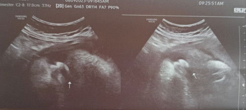 mag tatanong lang po sana, tingin nyo po ba boy na po xa? 😅 hoping kmai ng boy po eh😁thanks po....