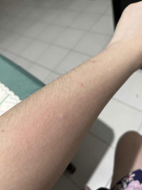 Gatal hampir sekujur tubuh #31weeks