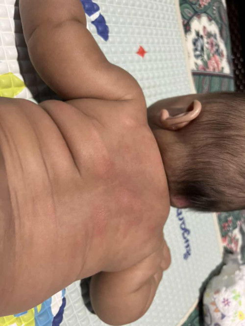 Ruam pada bayi