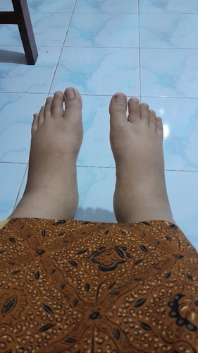 Mengatasi kaki bengkak habis melahirkan