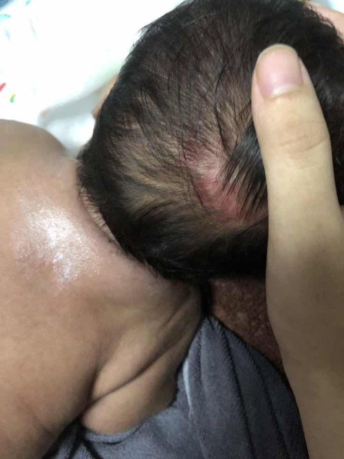 บ้านไหนเป็นแดงๆหลังศรีษะบ้างคะ