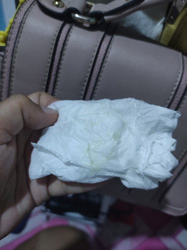 Normal lang po ba ang ganitong uri ng discharged?