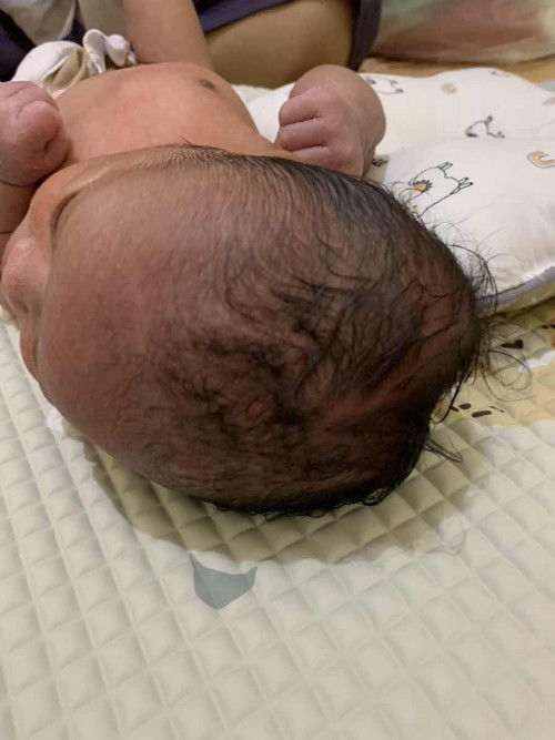 Benjolan di kepala bayi