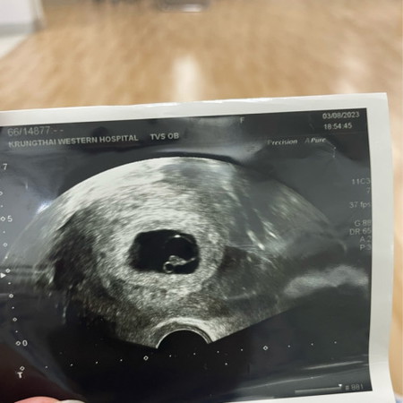 เด็กหยุดการเจริญเติบโต 8week