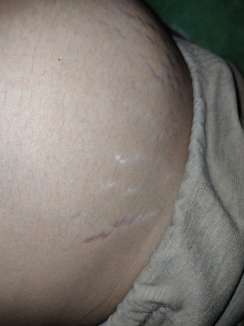 ท้องแตกลาย