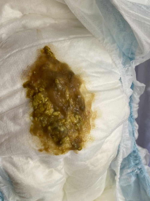 Normal ba na poop ng baby to?