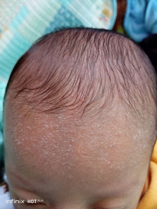 Bintik bintik putih di kepala bayi