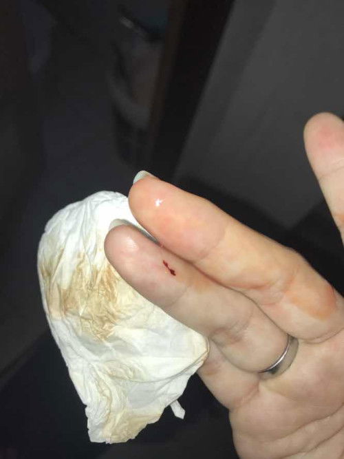 แบบนี้ควรไปโรงพยาบาลมั้ยคะ