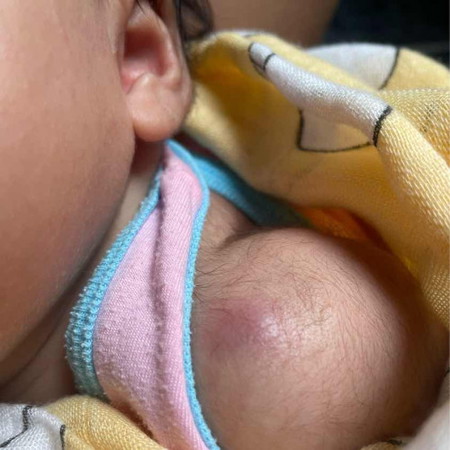 สอบถามแม่ๆค่ะแบบนี้น้องเป็นฝีรึป่าวค่ะ พอดีลูกคนแรกค่ะ น้องพึ่ง1เดือน2วันเองค่ะ 🥹