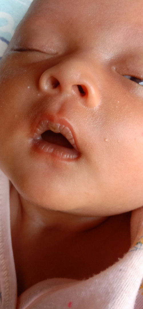 bibir tebal pada bayi baru lahir