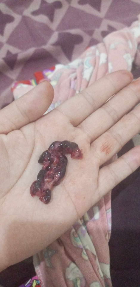 Tanong ko lang po ano po kaya ito. Kasi angtagal sobra ng bleeding ko parang isang linggo na mahigit