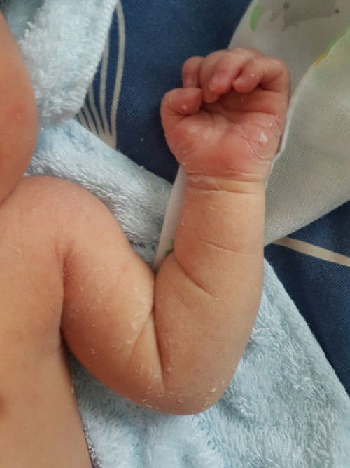 ลูกอายุ 3 วัน ผิวลอก