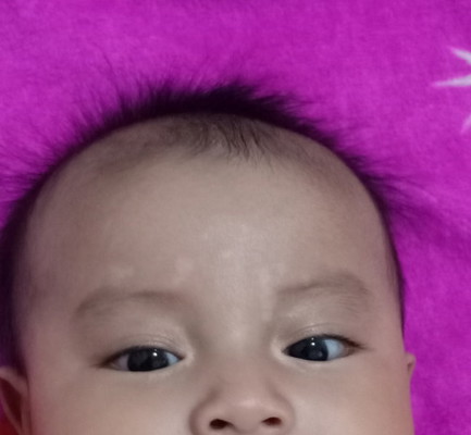 Mom, Bercak putih diatas dahi bisa dihilangkan dengan memakai apa ya?