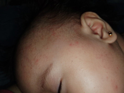 RASHES NI BABY