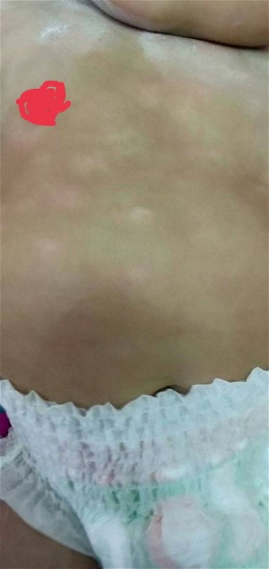 ลูกเป็นด่างๆขาวๆที่หน้าอก