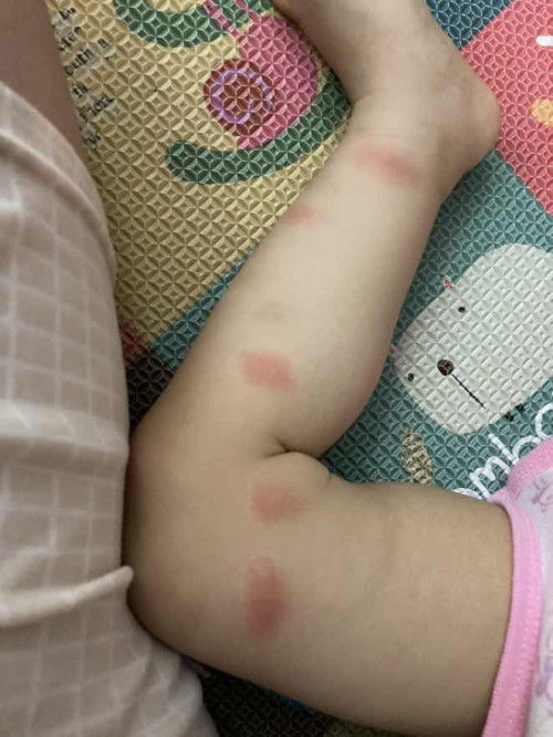 Are these red rashes or insect bites?