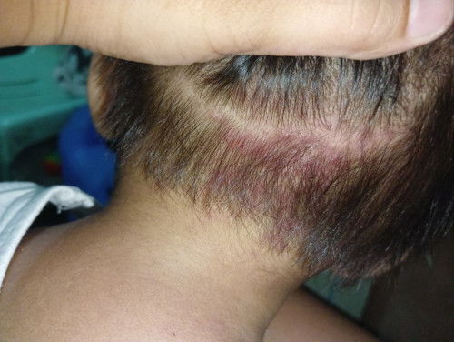 Mga mommy bungang araw po ba ito?